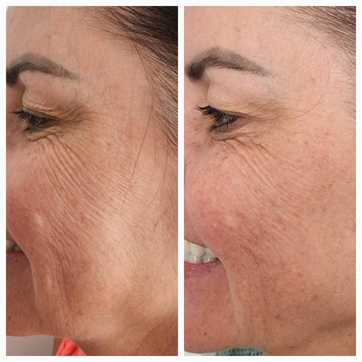 Bio Remodelling - Face Works