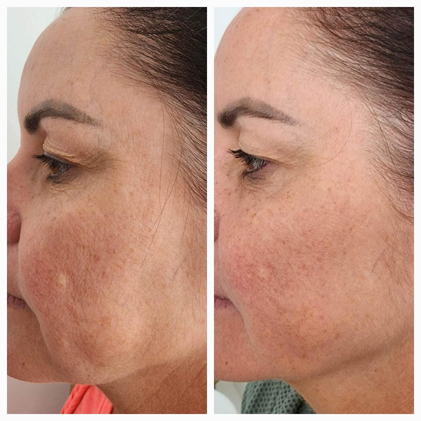 Bio Remodelling2 - Face Works