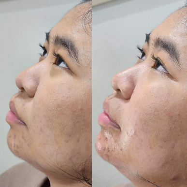 Chin Filler - Face Works
