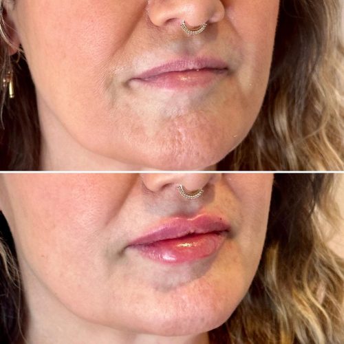 Dermal Fillers Lips