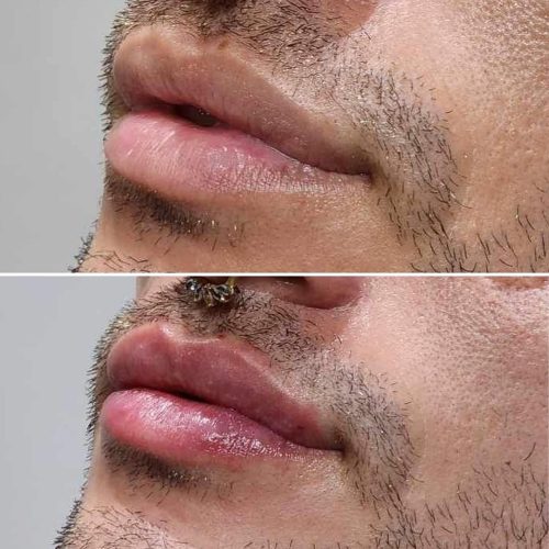 Dermal Fillers For Lips