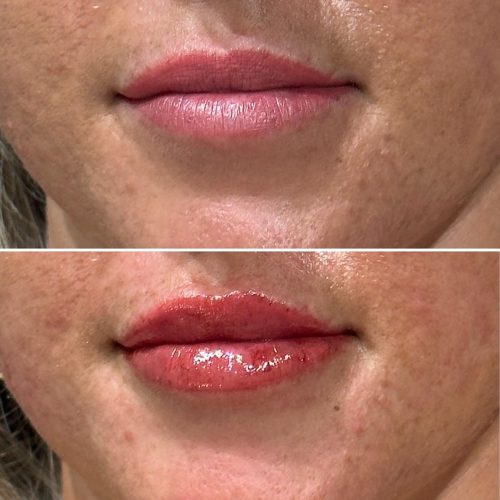 Lip Dermal Filler